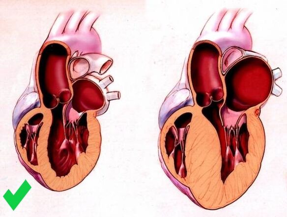 Cardione спречува вентрикуларна хипертрофија на срцето